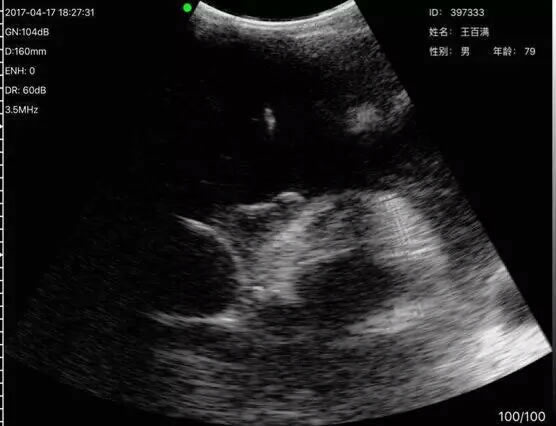 索诺星科技捐赠掌上超声援助抗疫医院